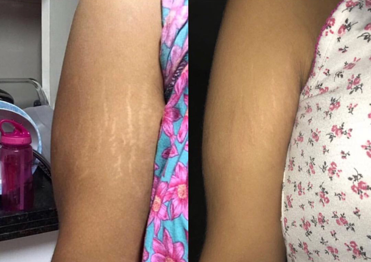 How to get rid of your Lipo Scars? Dark Scar Skin Camouflage treatments Scar  & Stretch Mark Camouflage Medical Tattoos