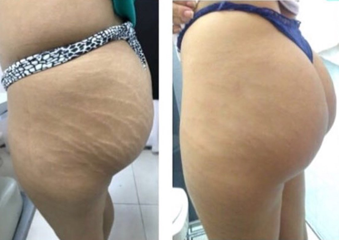 Authentic Medical Camouflage For Stretch Marks and Scars  Este