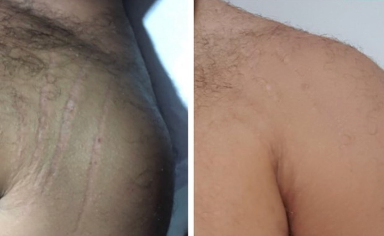 A Brazilian tattoo artist is making stretch marks disappear with ink  The  Independent  The Independent